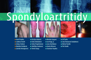 Spondyloartritidy