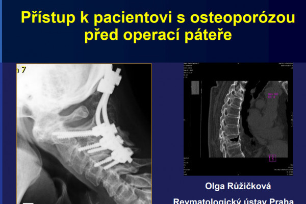 Příprava osteoporotických pacientů na spondylochirurgický výkon