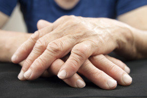 Biologické léky v léčbě revmatoidní artritidy